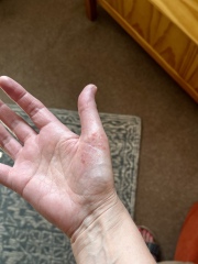 Pompholyx eczema