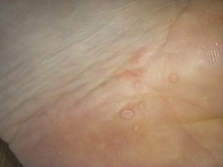 Spots on sole of foot