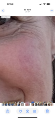 Skincare help - rosacea (?) treatments. Pic included