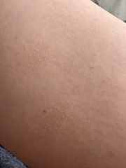 Extremely dry skin