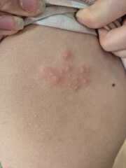 Rash on DD (12), seems to be getting worse