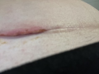 Is my c section wound infected?