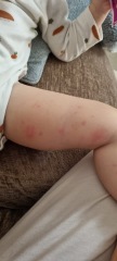 Raised bumpy rash on infant