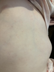 Unexplained rash after temp