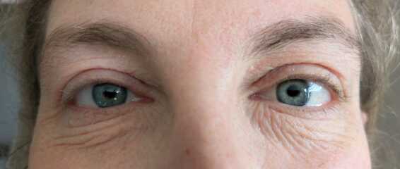 Eyes ageing me