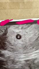 Concerned and upset with my first ultrasound?