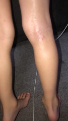 Rash? Or other
