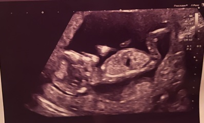 13 Week Scan Gender Guess