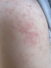 Toddler rash - very worried opinions very much appreciated