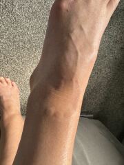 What are these raised bumps around an old scar?
