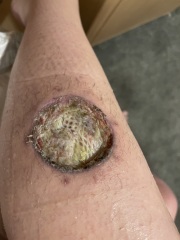 Cancer wound