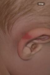 Ear bruise?