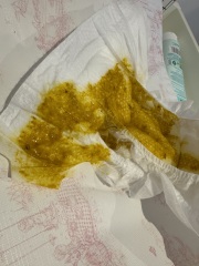 CMPA Baby Poop?