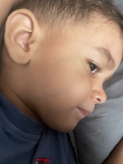 Dark veins on child’s face