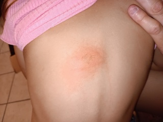 What is this on my daughters back?