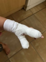 Child burnt at a forest preschool