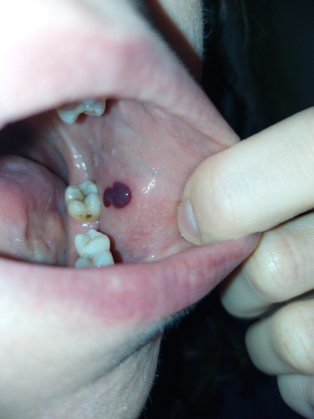 What's this in my mouth? Blood blister?