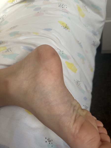To wonder if this is an infection tracking up my child’s foot?