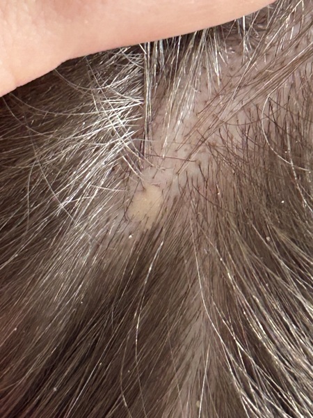 What is this on my scalp?