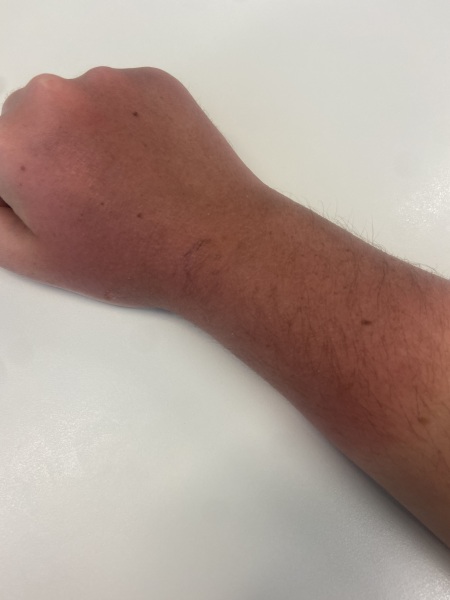 Anyone know anything about burns ?