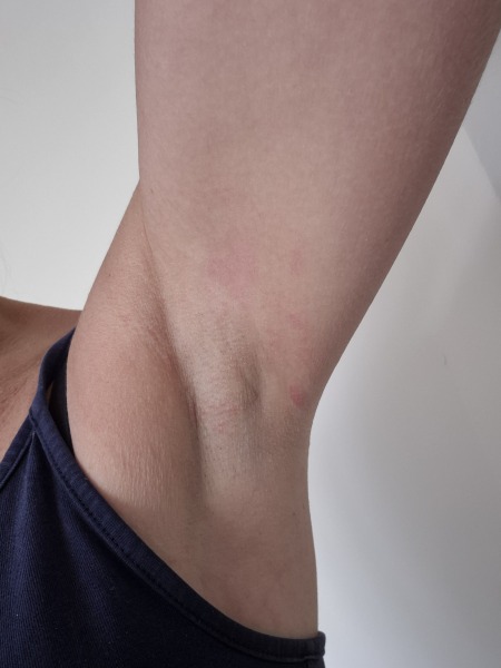 Armpit lumps - freaking out