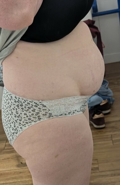 Can't feel my stomach muscles 2 years after c section