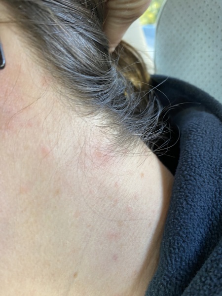 Rash down  side of neck