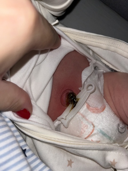 Umbilical cord infected????