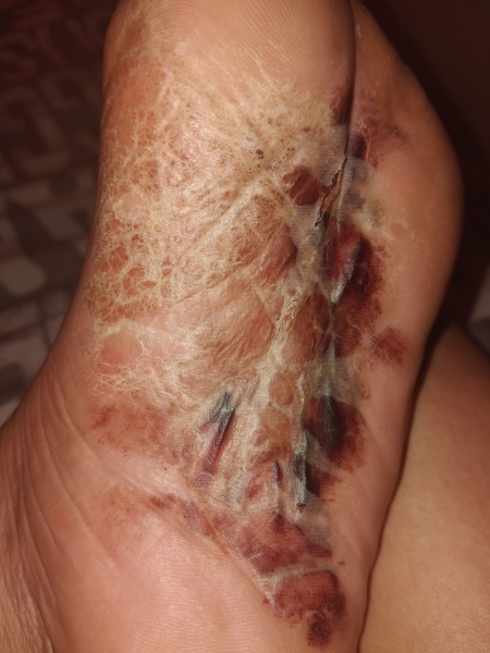 Shamelessly posting for traffic. Medical question and im definitely AIBU for posting disgusting pictures looking for answers