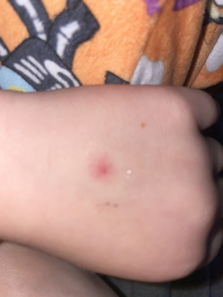 itchy red spot on DD5 hand that isn't going away - I'm not petrified