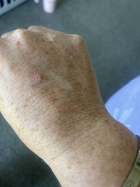 Lump on back of hand