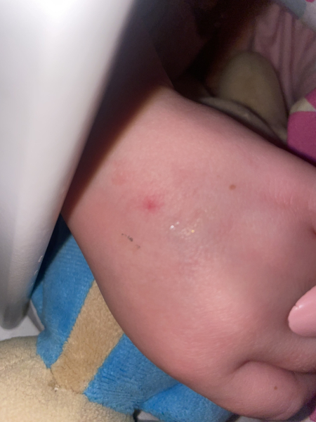 itchy red spot on DD5 hand that isn't going away - I'm not petrified