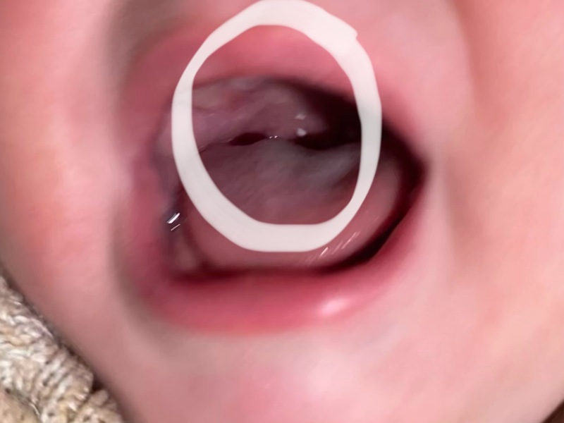 White spots on breastfed baby throat - Milk curds?