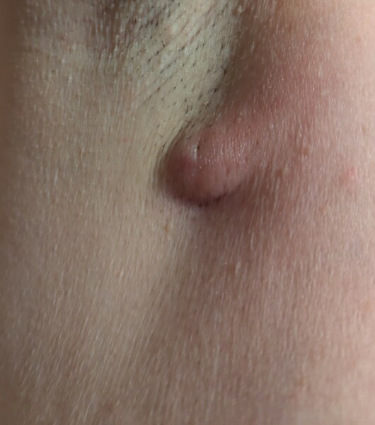 Armpit cyst infected