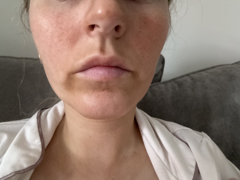 Perioral Mounds