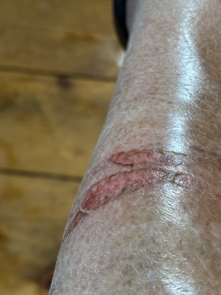 Burn from cooker door