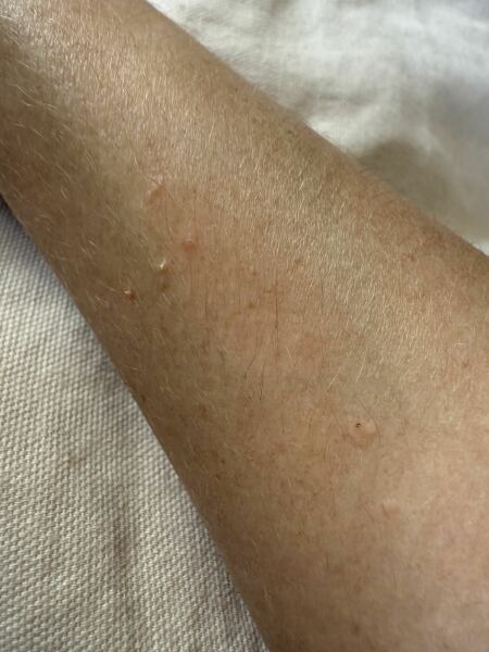 What are these spots on my arm? Do I need a GP appointment? (Photo included)