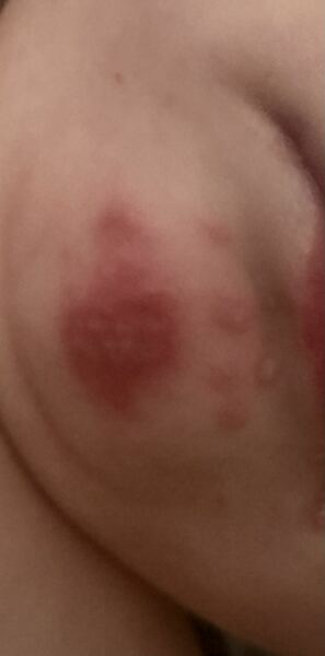 What do you think this rash is?