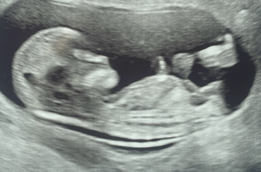 Any early gender predictions? 12w4 xx