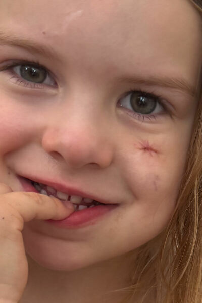 Haemangioma/propranolol