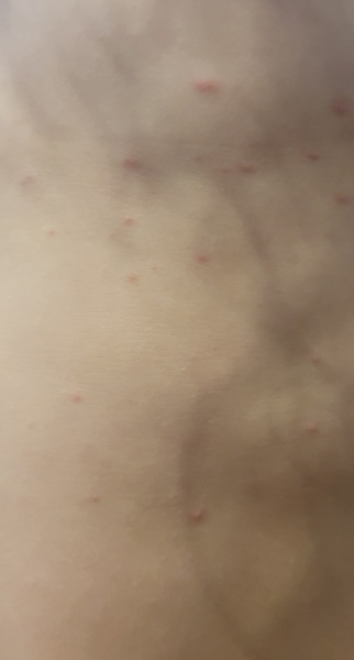 Going to the shop with Chicken Pox?