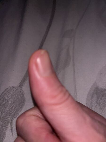 Is my finger infected?
