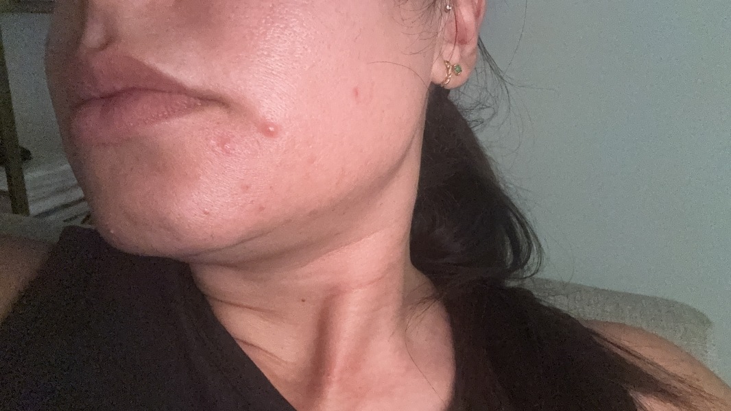 ACNE breakout - HELP