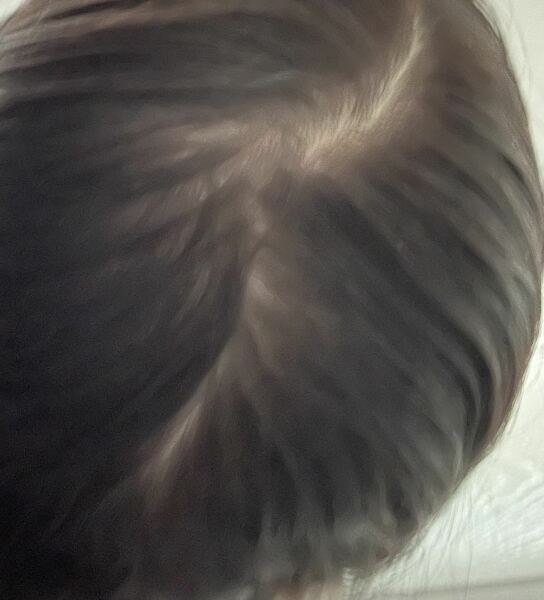Hair loss