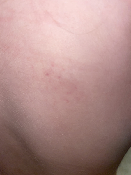 Small patch of what I think is petechiae on DD back. I am spiralling with healt anxiety