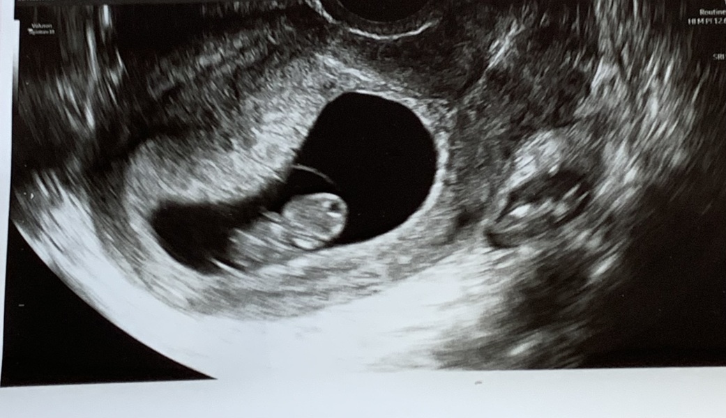 Can anyone tell me if this looks like a single ot twin pregnancy