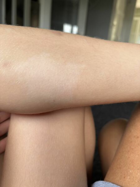 White patch on leg