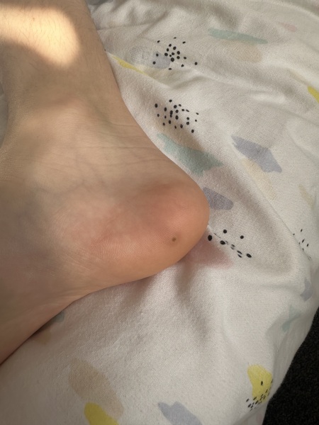 To wonder if this is an infection tracking up my child’s foot?