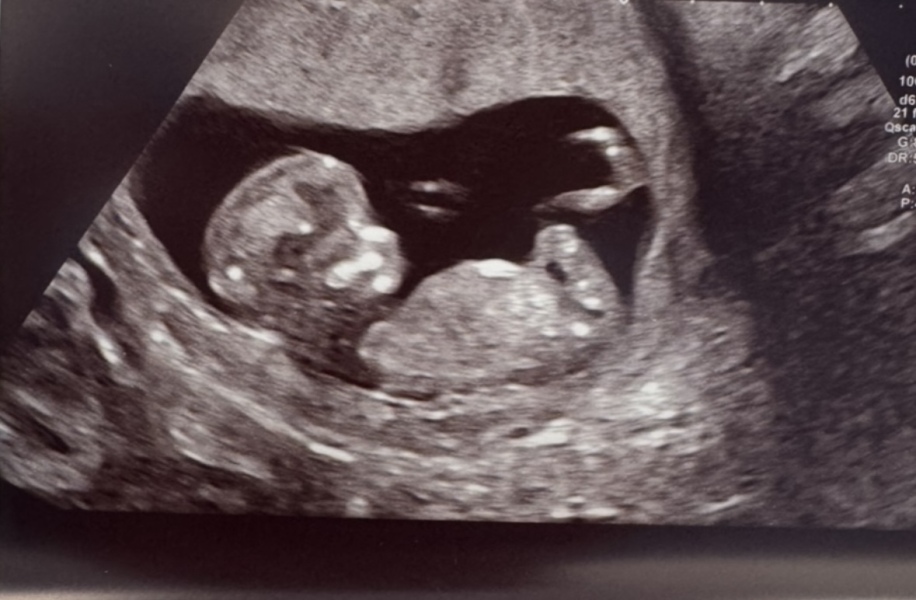 Boy or Girl at 12 weeks