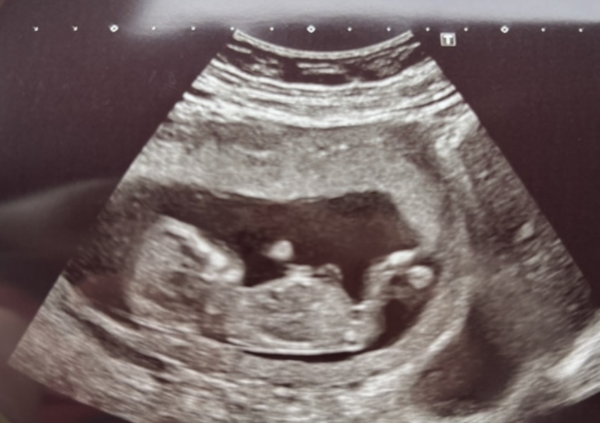 Boy or Girl Predictions